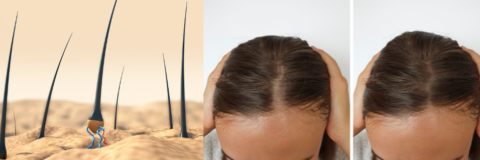 Progesterone: How It Nurtures Hair Growth