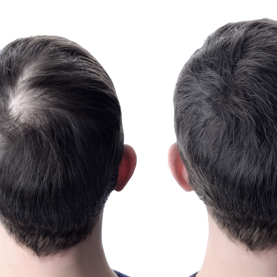 RootRenew Finasteride – Men’s Growth