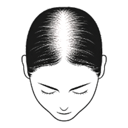 Female hair loss pattern: complete