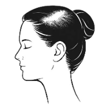 Female hair loss pattern: crown