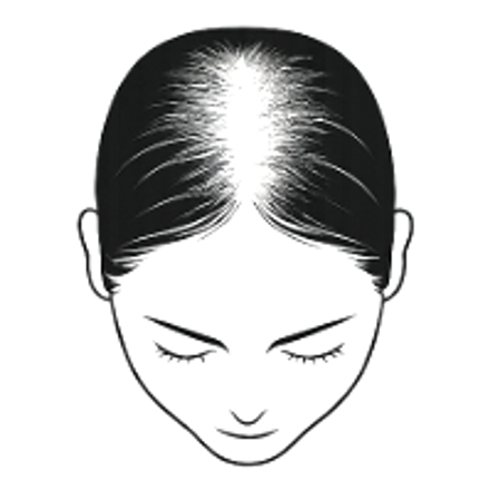 Female hair loss pattern: extensive