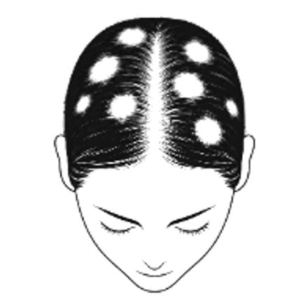Female hair loss pattern: patchy