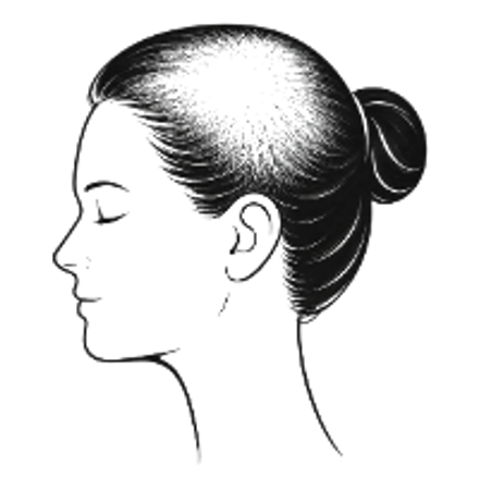 Female hair loss pattern: temples crown