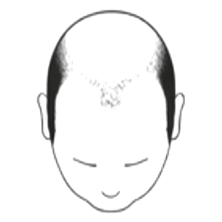 Male hair loss pattern: complete