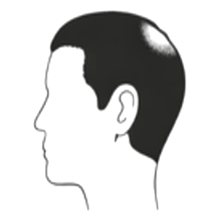 Male hair loss pattern: crown
