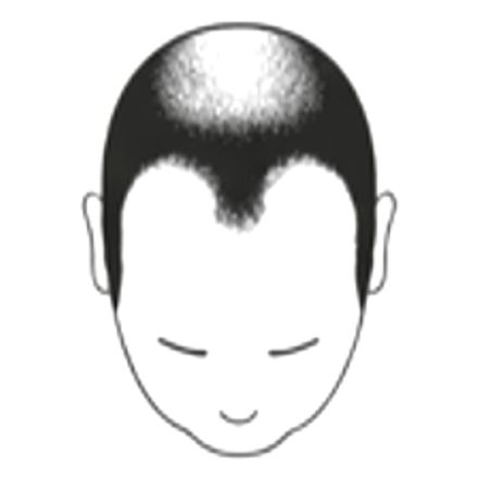 Male hair loss pattern: extensive