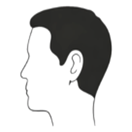 Male hair loss pattern: moderate