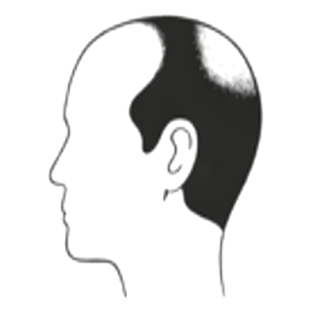 Male hair loss pattern: patchy